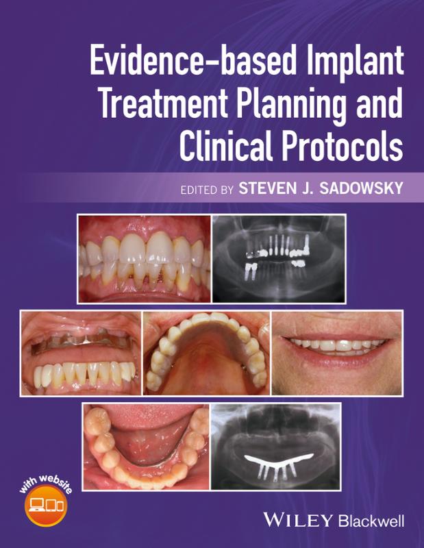 Evidence-Based Implant Treatment Planning and Clinical Proto